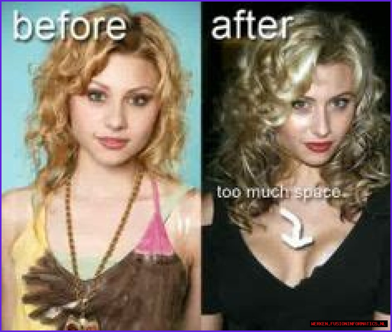 Aly Michalka Plastic Surgery Before and After